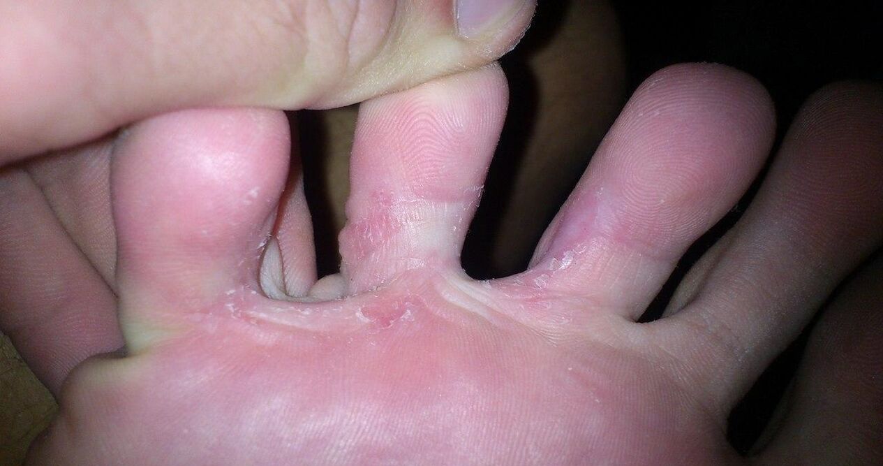 Cogomelo entre os dedos para o tratamento da crema de demyxil
