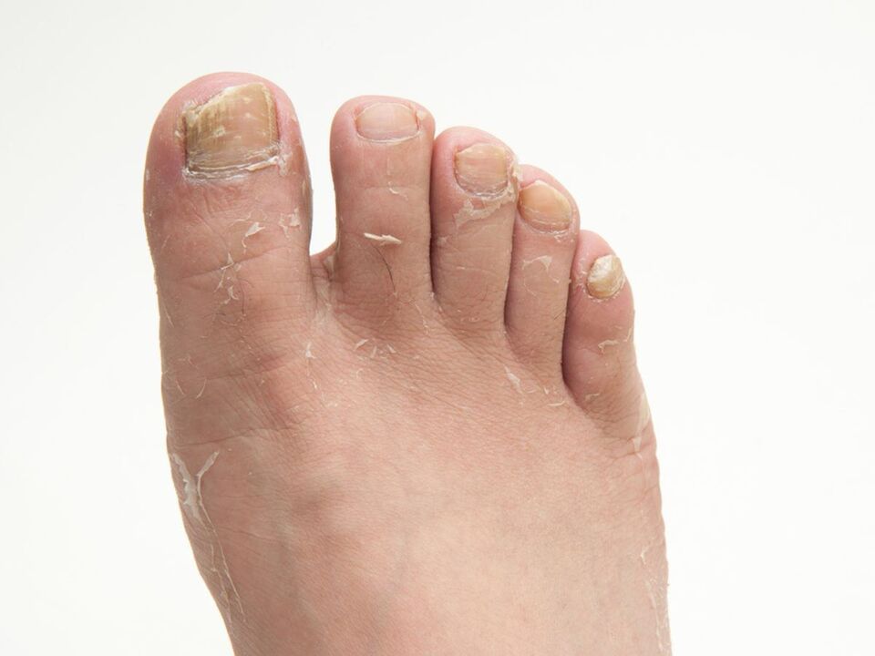 Cogomelo na pel das pernas e o seu tratamento con crema zxcvbnmqwort