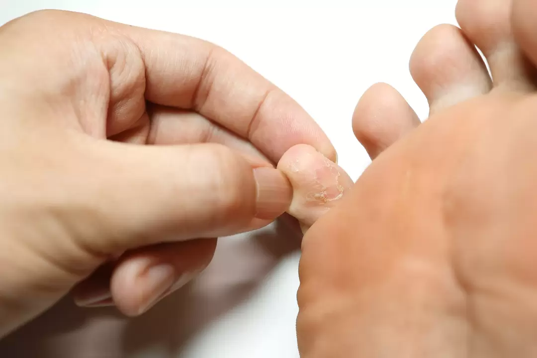Cogomelo sobre os dedos e o tratamento con crema de demyxil