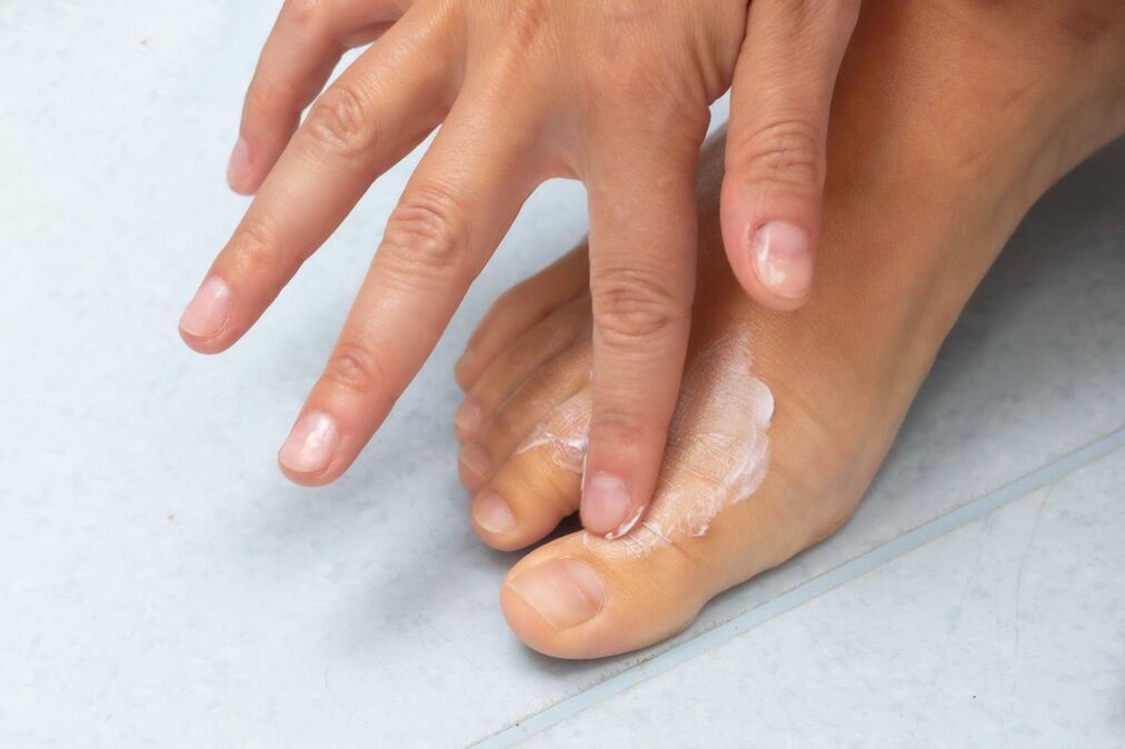Crema demyxil do cogomelo entre os dedos dos pés