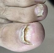 Comezou o fungo das uñas