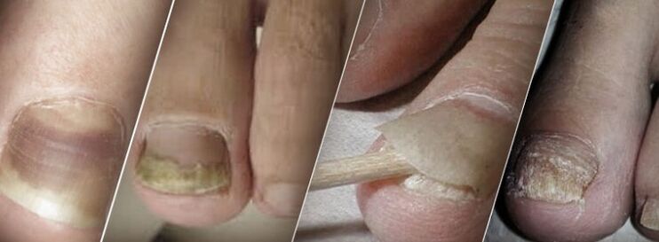 Onicomicosis