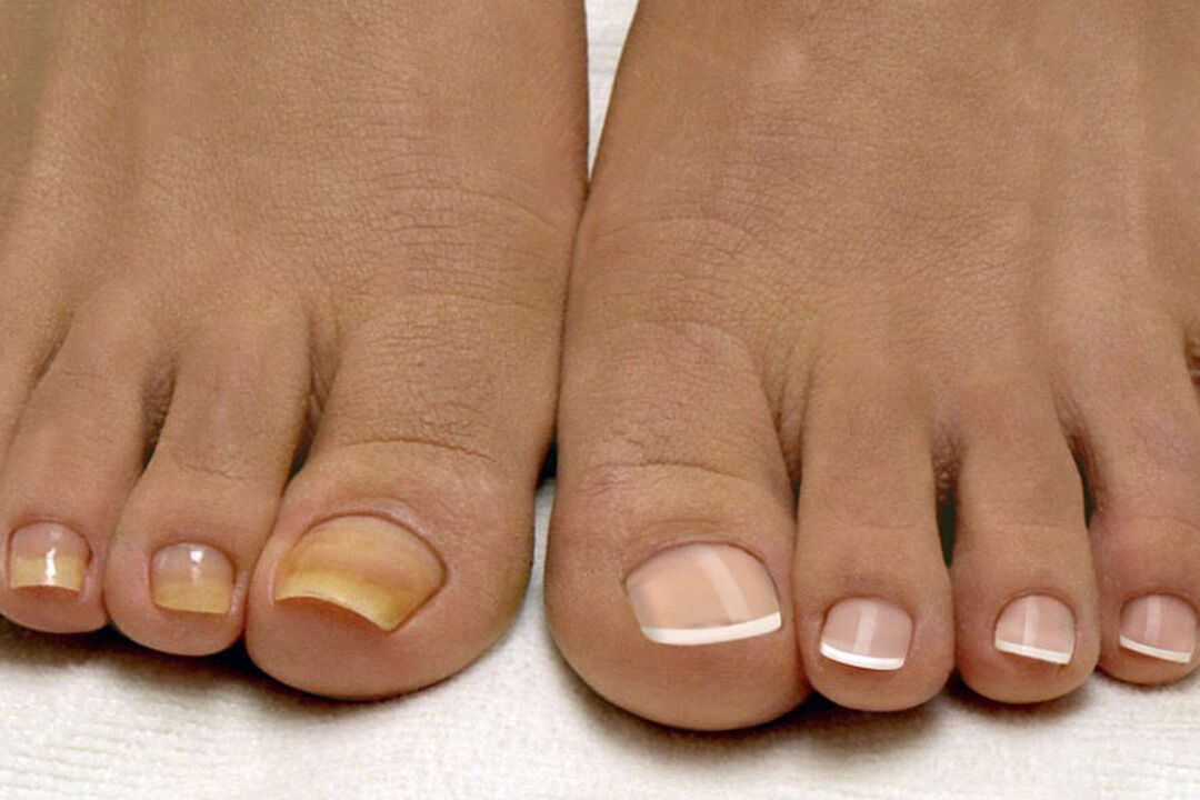 Uñas saudables do outro lado cun cogomelo nunha perna