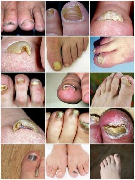 Infección fúngica da placa da unha do pé