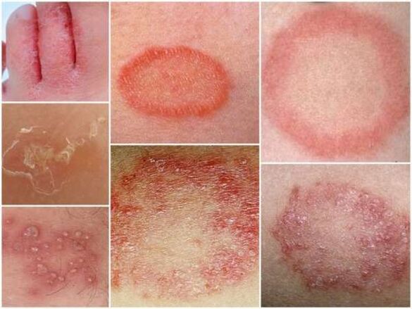 Tricofitose da pel das pernas