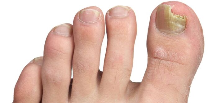 Infección fúngica da placa ungueal